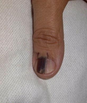 一般来说健康的指甲是什么样子,健康指甲的正常颜色