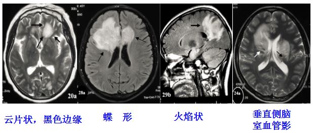 医学干货：瘤样炎性脱髓鞘病与胶质瘤、PCNSL临床、影像鉴别