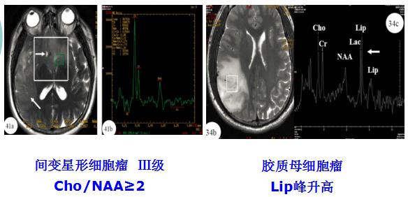 医学干货：瘤样炎性脱髓鞘病与胶质瘤、PCNSL临床、影像鉴别