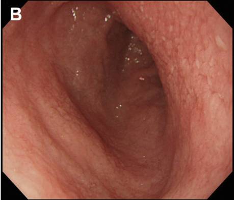 腹泻的不同类型及病例,腹泻的不同原因及现象