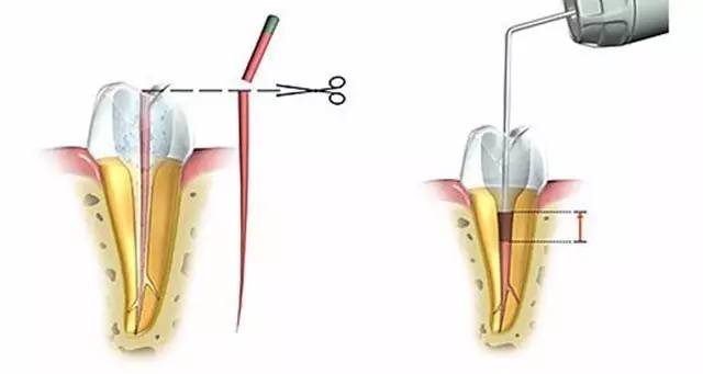 什么是根管治疗流程,什么是根管治疗全过程解说
