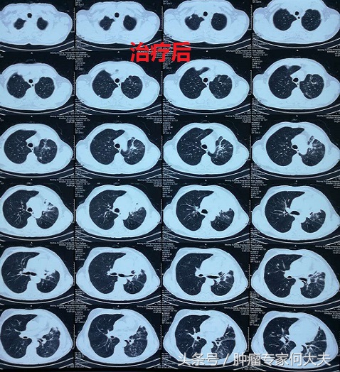 73岁老人得肺癌不治疗能活多久,77岁老人癌症晚期忽然喘不过气