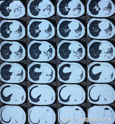 72岁老爷子,肺癌晚期,喘不上气,经这么一治疗竟然好多了