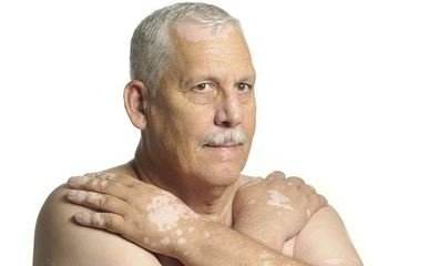 掩耳盗铃,纹身也救不了你的白斑!