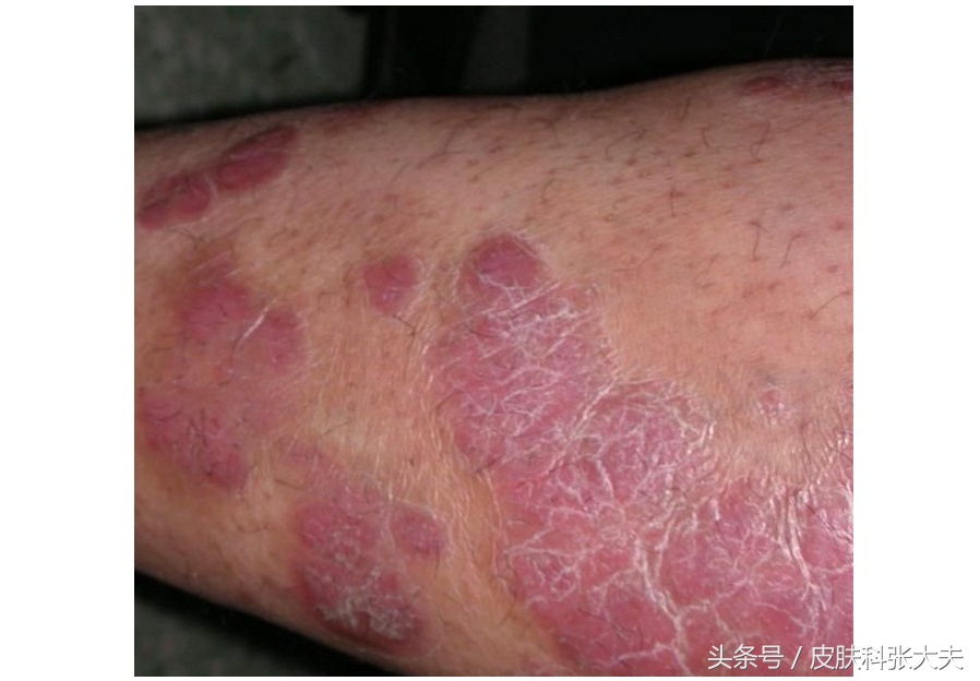 牛皮癣如何防止加重,牛得牛皮癣怎么治疗能彻底根除