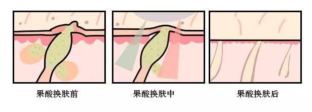 第二天要穿吊带如何解决背后痘痘,后背有痘痘穿吊带的急救办法