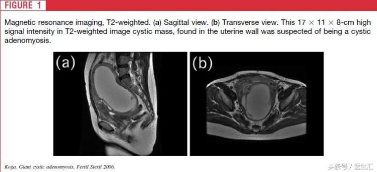 年轻子宫腺肌症患者综合治疗的病例分析