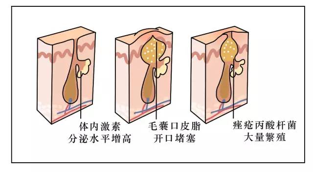 背上痘痘夏天怎么穿吊带,背后长痘痘怎么穿小吊带