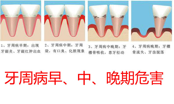 牙周病经久不愈要注意了，你可能是得了糖尿病！