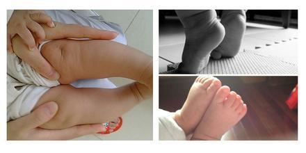 关于小儿“内翻足”的亲身经历，宝宝站不稳就一定是‘畸形’吗？