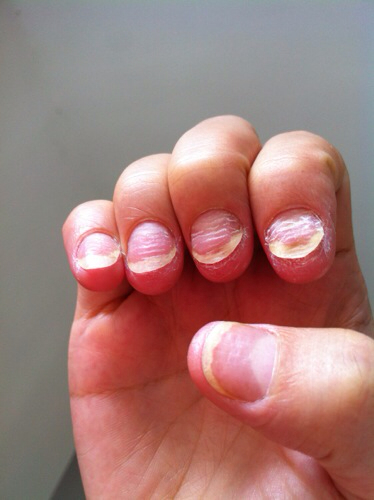 被甲沟炎反复折磨,被甲沟炎折磨了好几年