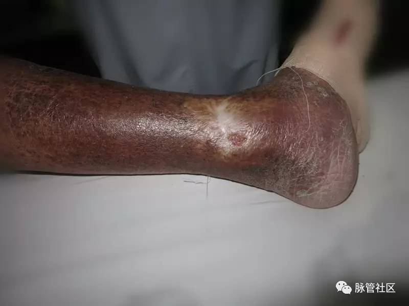 下肢静脉曲张脚踝皮肤痒,下肢静脉曲张科普视频