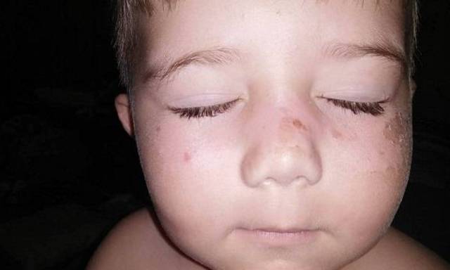 宝宝烧伤应该抹什么药膏,宝宝烧伤结痂应该抹什么药膏