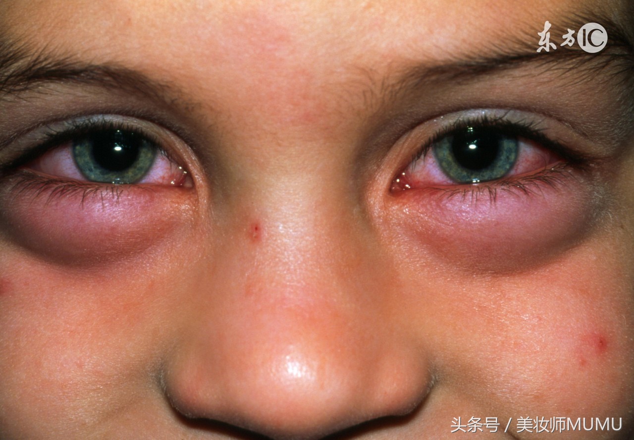 眼睛撞伤肿了需要热敷还是冷敷,小孩眼睛肿了用热敷还是冷敷