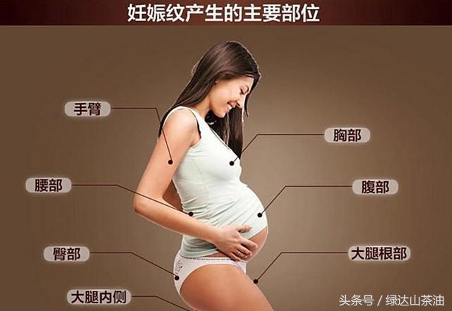 有效祛妊娠纹的产品推荐,除妊娠纹的国产神器