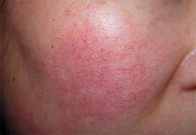 一着急脸红发烫什么原因,一热就脸红发烫头晕是怎么回事