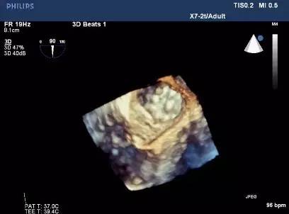 「病例」80岁房颤患者抗凝治疗后反复咯血，咋办？