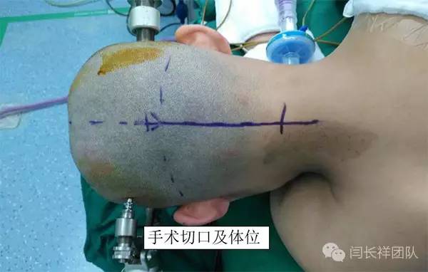 喝水容易呛是怎么回事是肺癌,老人喝水容易呛咳怎么办