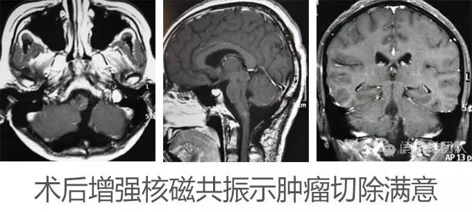 喝水容易呛是怎么回事是肺癌,老人喝水容易呛咳怎么办