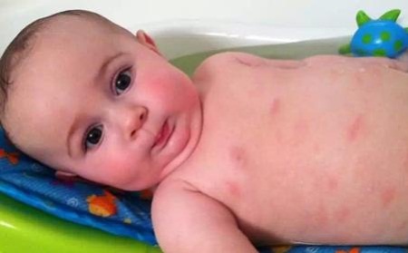 宝宝起湿疹能不能总用药,宝宝出湿疹用什么药膏好