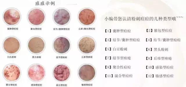 美讲堂,战痘持久战