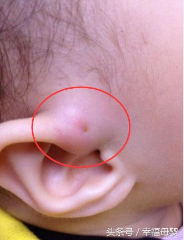 宝宝耳朵内侧有个小针眼洞,两个月的宝宝左耳耳前瘘管