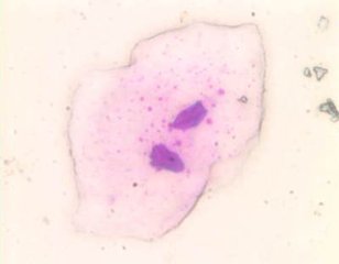 血尿里面有什么成分,血尿的原因和危害及其饮食禁忌