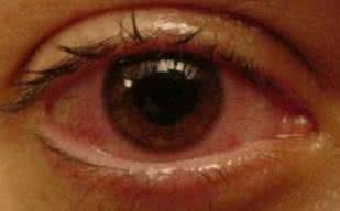 口腔和外阴同时长溃疡需警惕，别是这种疾病