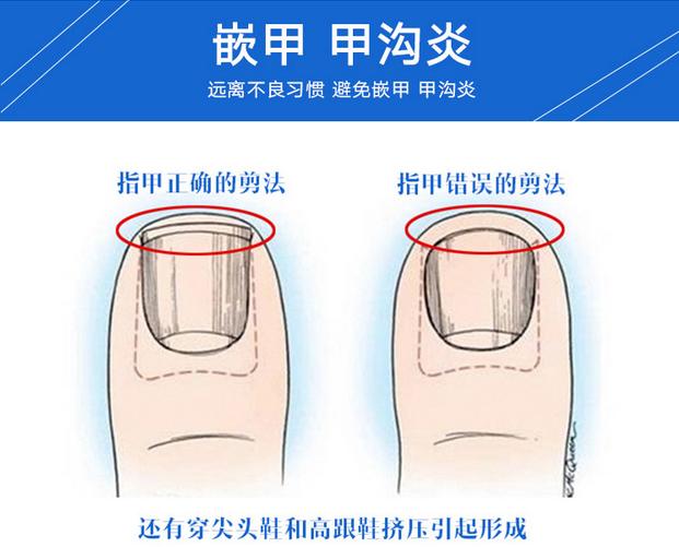 脚趾甲长肉里很深剪不出来怎么办,脚趾甲长到肉里只需一招