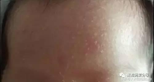宝宝长痱子怎么办？如何预防、治疗这篇全都有！