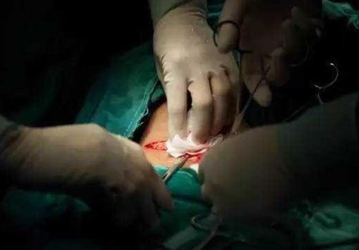 产后护理的风险及对策,剖宫产后伤口感染会造成什么影响