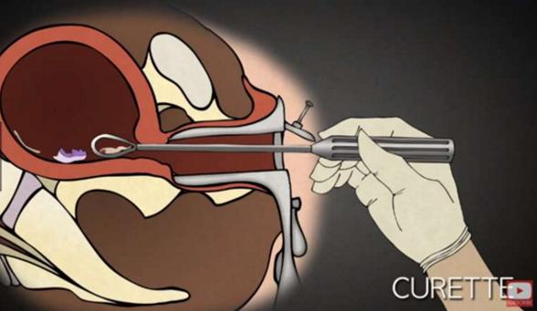 堕胎手术详细流程,女性堕胎手术的可怕真相