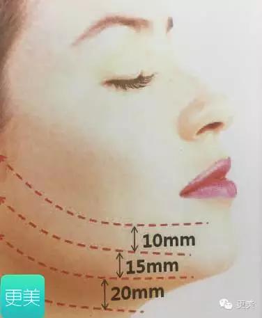 脸部缝美容线好还是普通线好,医院埋线和美容院埋线有什么差别