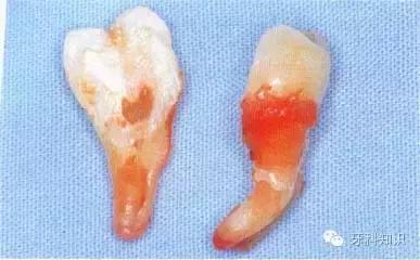 口腔拔牙图片,口腔拔牙麻醉多久消退