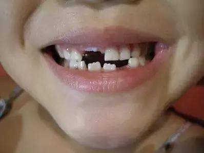 牙齿楔状缺损疼痛怎么办,儿童牙齿有缺损怎么治疗