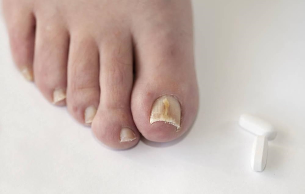 灰指甲是手足癣吗,解析灰指甲的六大临床症状