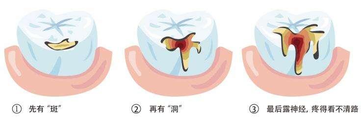 宝宝长虫牙啦正在换牙要怎么办,儿童漱口水可以预防虫牙