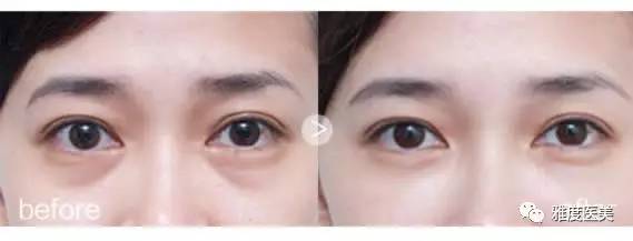 郑爽泪沟、眼袋明显到糊住镜头，学生*党**们的通病该怎么治？