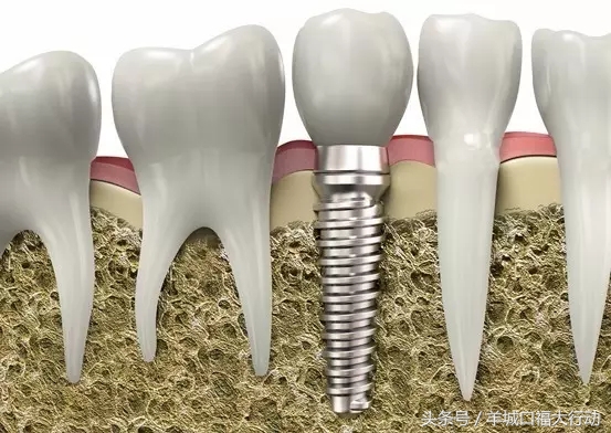 种植牙的八大优势你知道吗,种植牙的优势动画视频