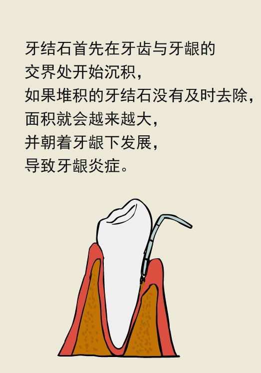 为什么洗牙以后还要做牙周刮治,为什么洗牙后还要刮治