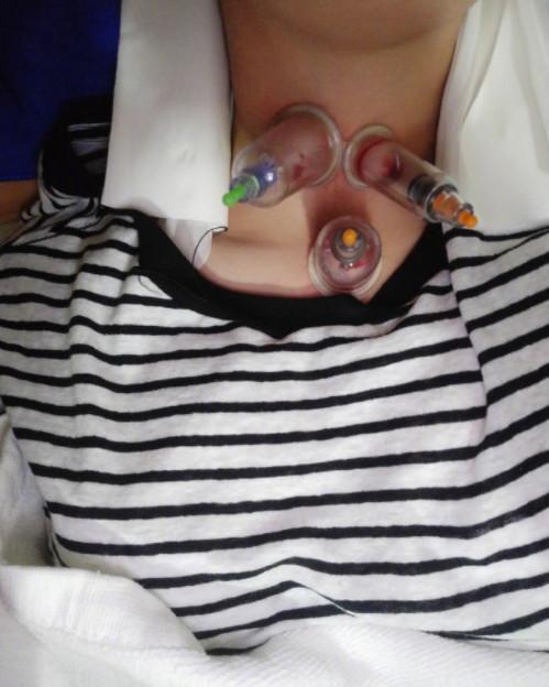 杨幂中医视频,杨幂针灸放血治疗