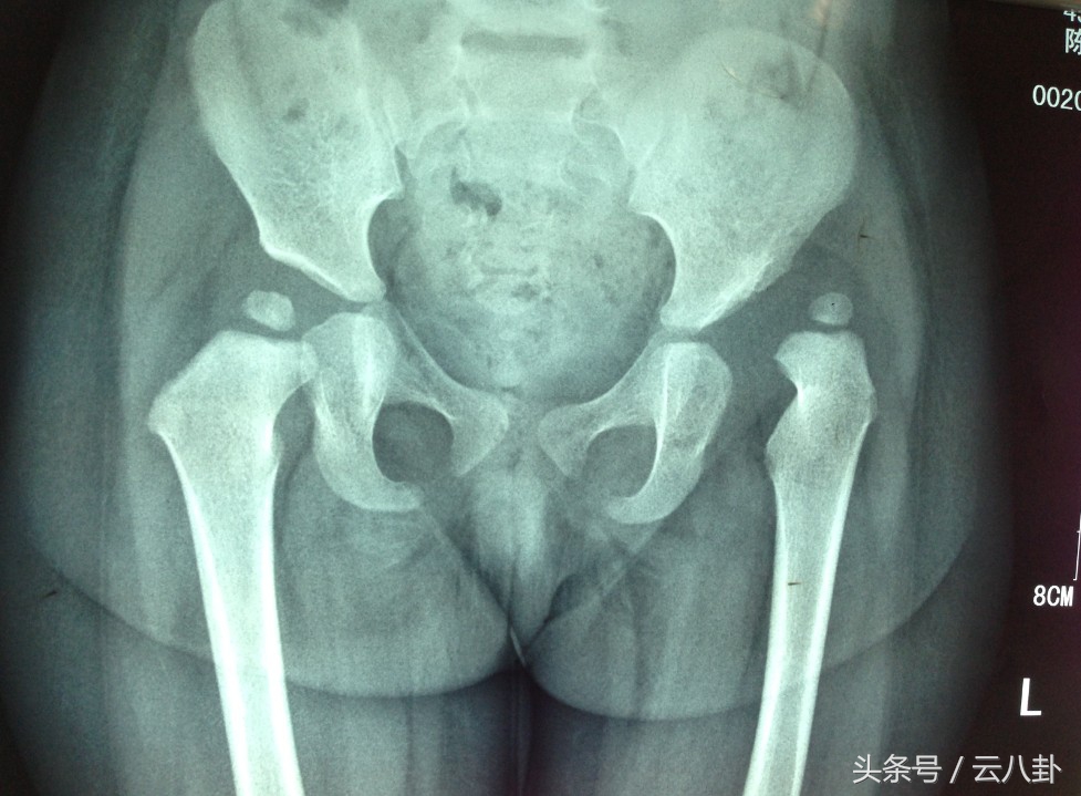 小孩双腿关节不对称,幼儿腿关节有响声挂什么科