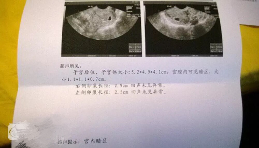 备孕常见问题解答：孕早期B超看不到孕囊怎么办？什么时候第一次B超最为合适？