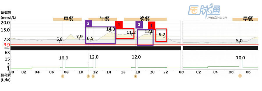 胰岛素泵动态监测血糖,泉信济南