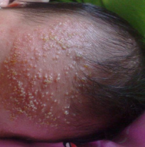 湿疹用糖皮质激素类药膏有哪些,小孩湿疹不含激素药膏