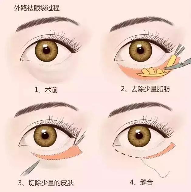 切除眼袋是唯一解决眼袋的方法,眼袋切除方法有哪些