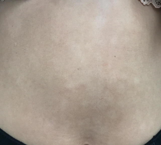 肚子上有类似汗斑,肚皮上有褐色的斑是不是汗斑