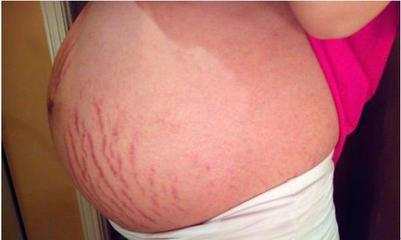 孕妇生完孩子肚皮一定会皱巴巴吗,孕妇生完后肚子一层皮