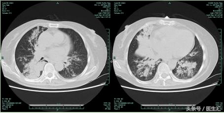 术后病人发热怎么处理,外科术后发热