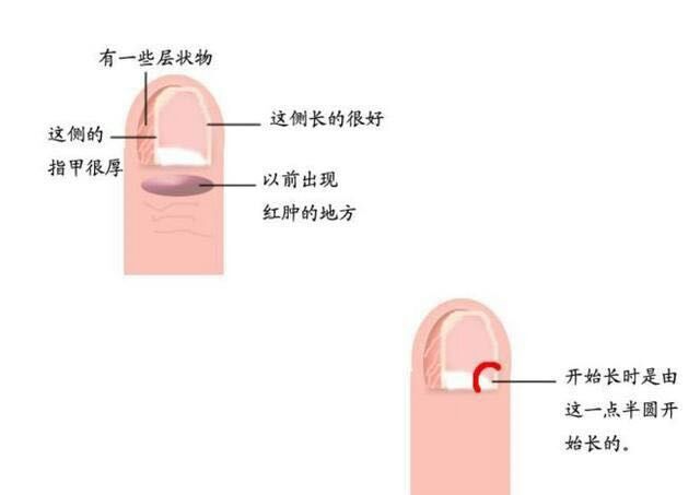 脚趾甲长到肉里很疼怎么止疼,脚趾甲长肉里一碰就痛咋办